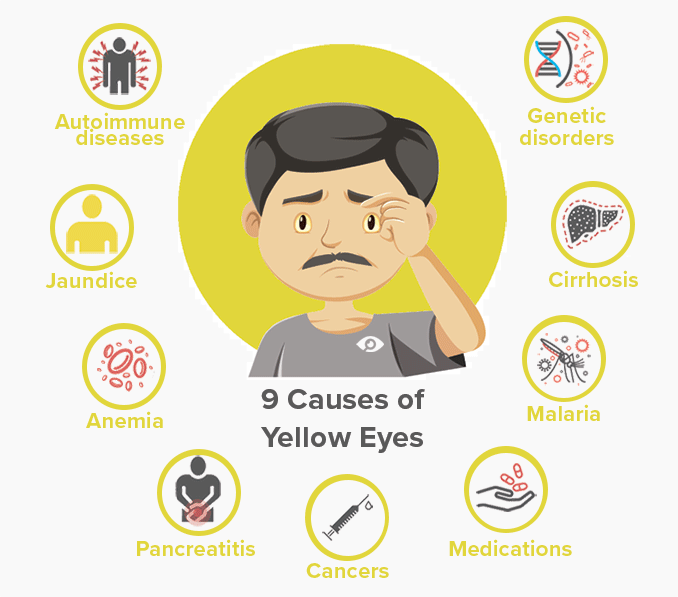 https://cdn.allaboutvision.com/yellow-eyes-causes-678x600.gif