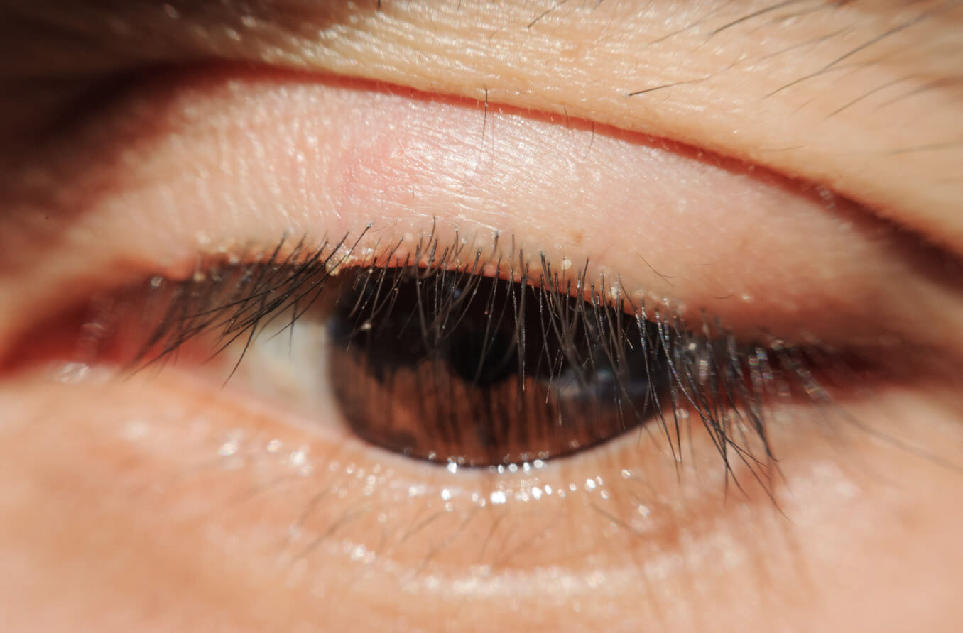 Woman with red eyelids