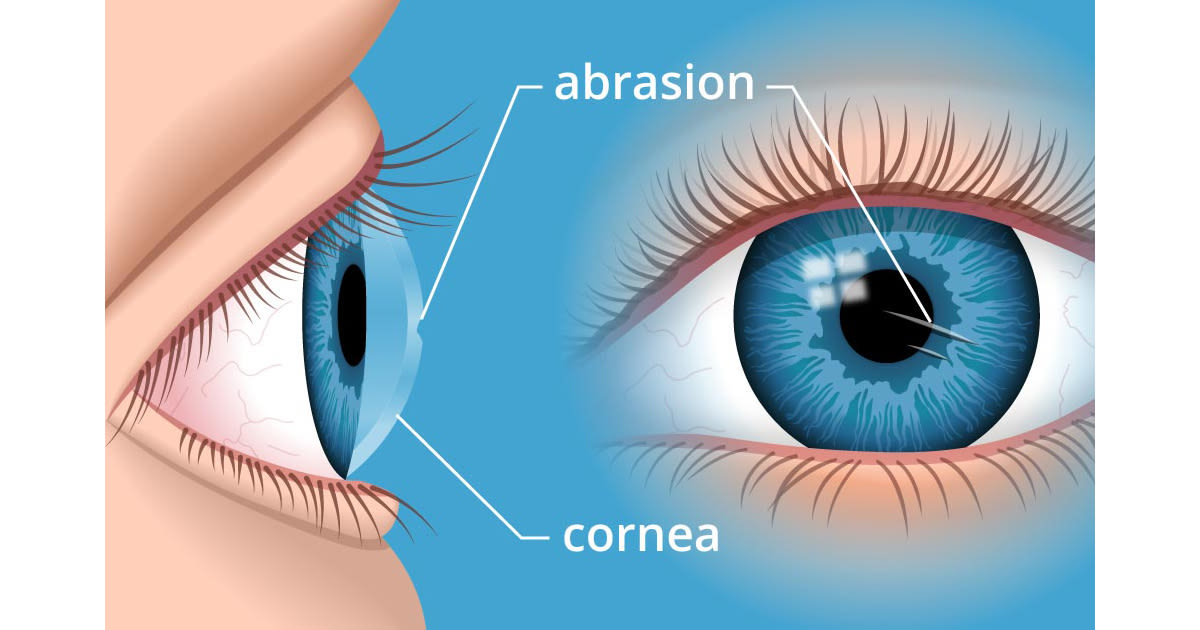 Illustration of a corneal abrasion