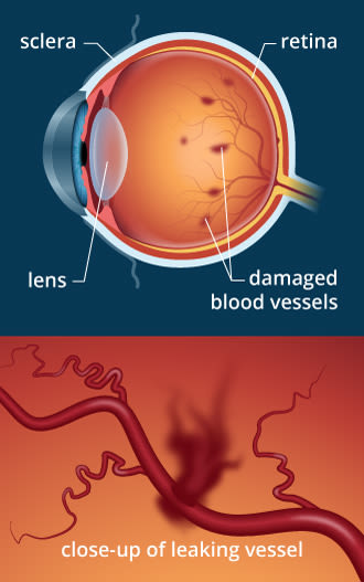 https://cdn.allaboutvision.com/images/diabetic-retinopathy-330x527@2x.jpg