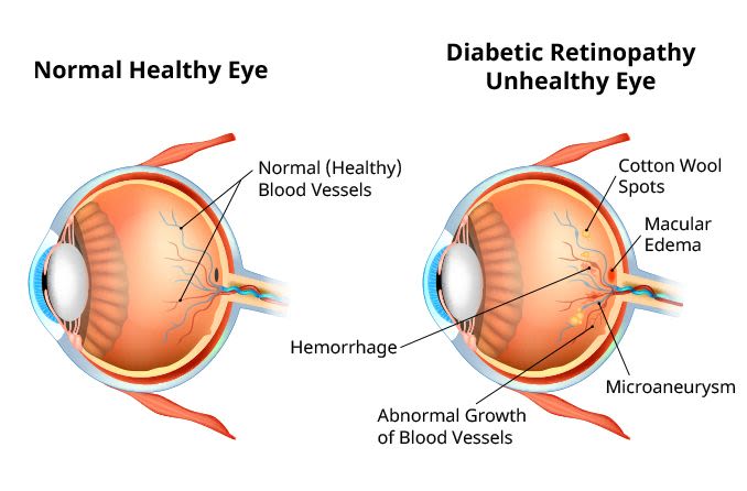 diabetic retinopathy eye diagram