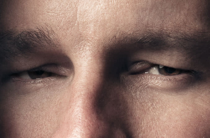 person with swollen eye lids