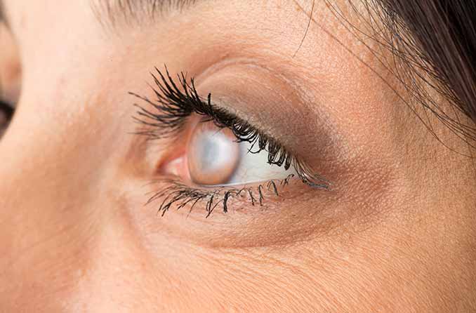 a nurse applying drops for cataracts