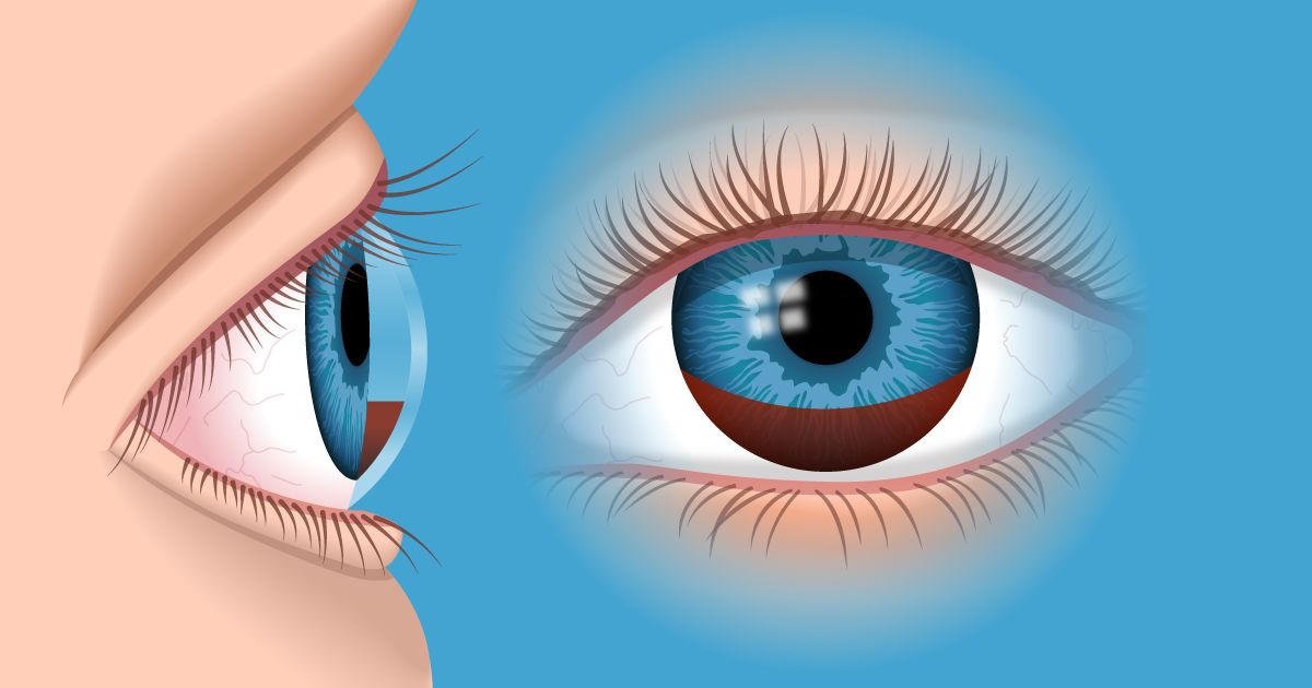 hyphema illustration