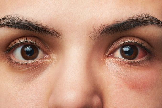 Close-up of a woman with conjunctivitis (pink eye).