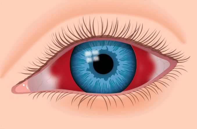 illustration of a subconjunctival hemorrhage