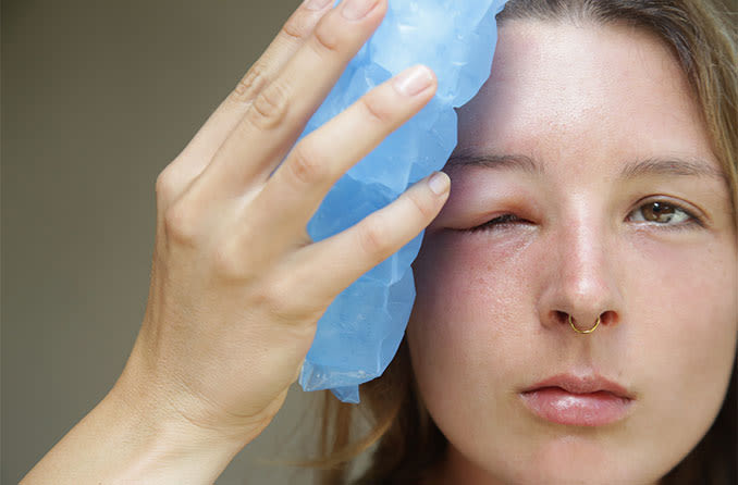 woman with a swollen eyelid